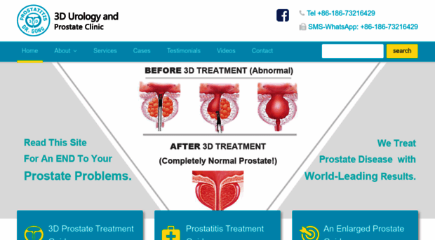 3dprostatecure.com