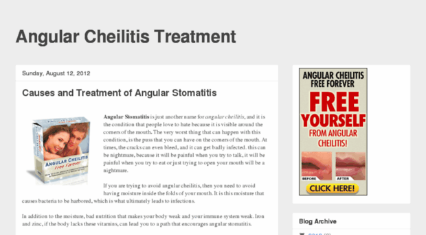 angularcheilitistreatmentandcure.blogspot.com