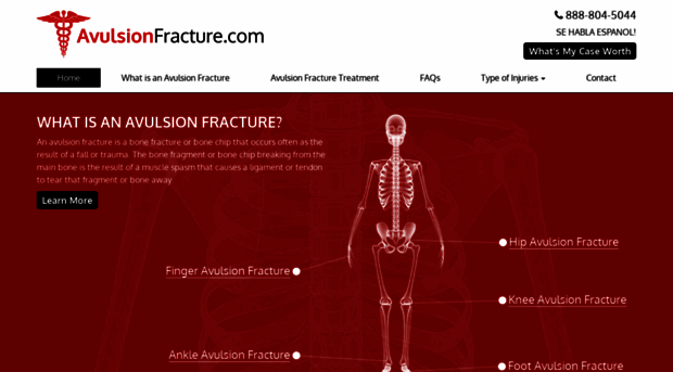 avulsionfracture.com