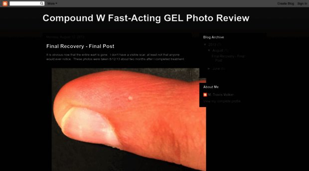 compound-w-fast-act-gel-photo-review.blogspot.com