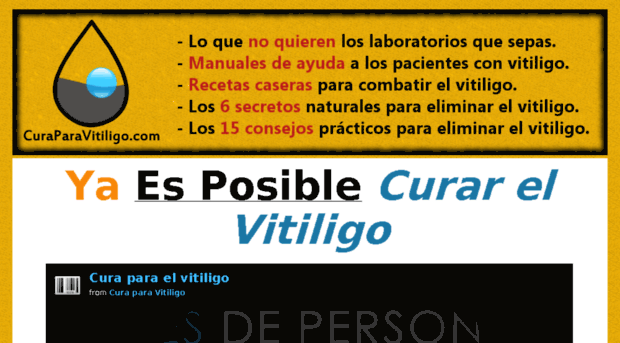 curaparavitiligo.com