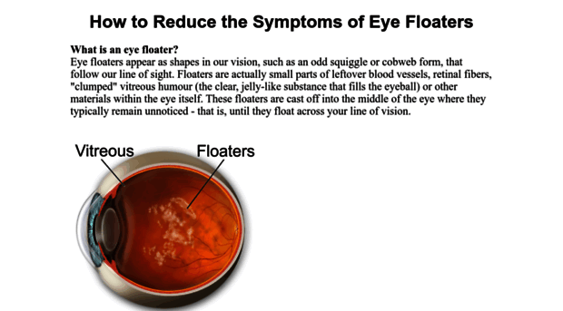 cure-eye-floaters.com