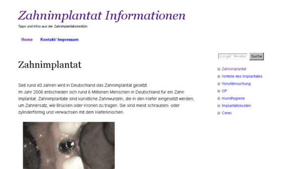 das-zahnimplantat.net