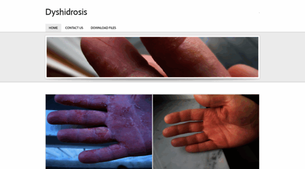 dyshidrosis.co.uk