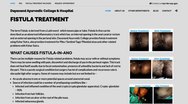 fistula-treatment.com