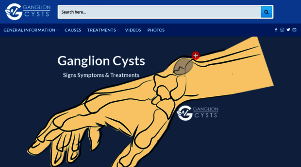 ganglioncysts.com