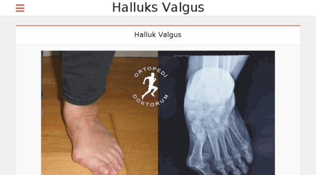 halluksvalgus.com