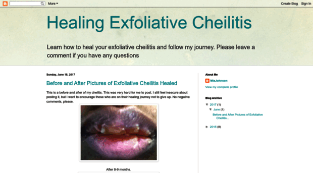 healingexfoliativecheilitis.blogspot.sg