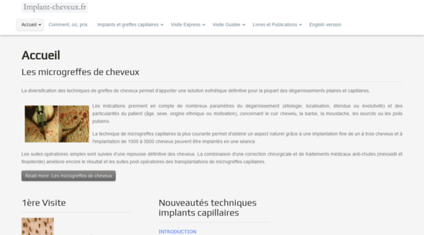 implant-cheveux.fr