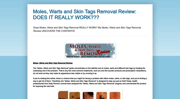 moleswartsandskintagsremoval-review.blogspot.com