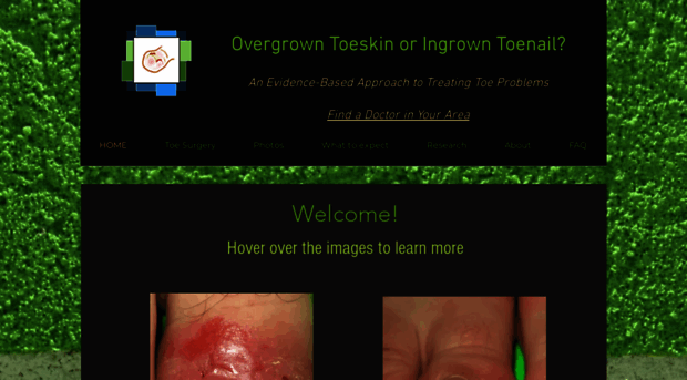 overgrowntoeskin.ca