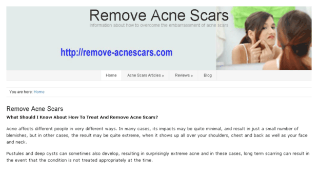 remove-acnescars.com