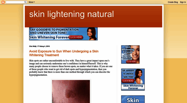 skinlighteningnatural.blogspot.com