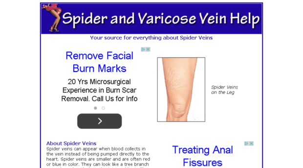 spider-vein-help.com