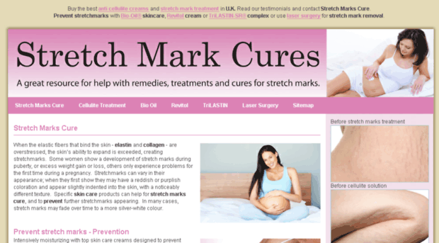 stretch-marks-cure.co.uk