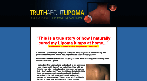 truthaboutlipoma.com