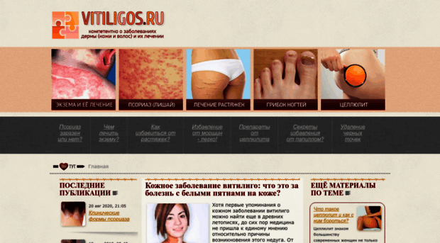 vitiligos.ru